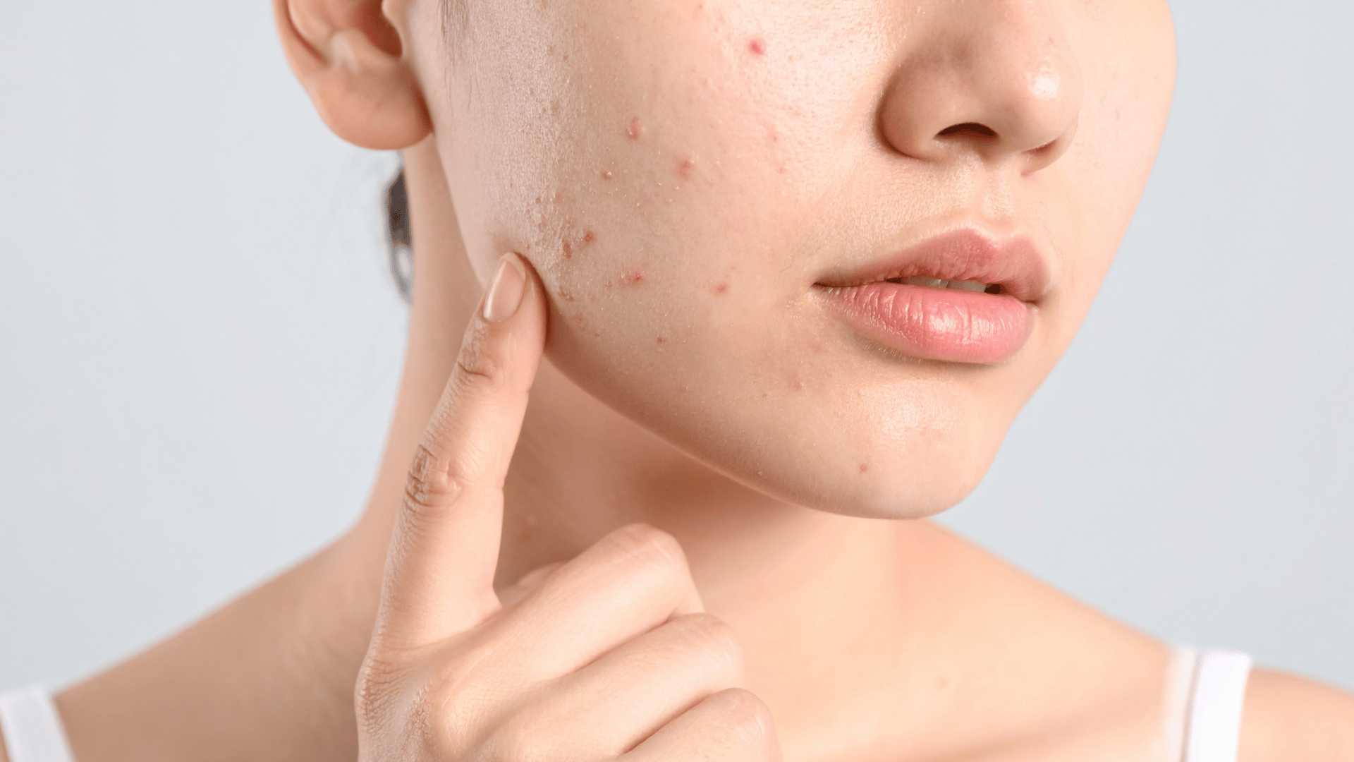 Acne after summer: why breakouts happen and how to calm them