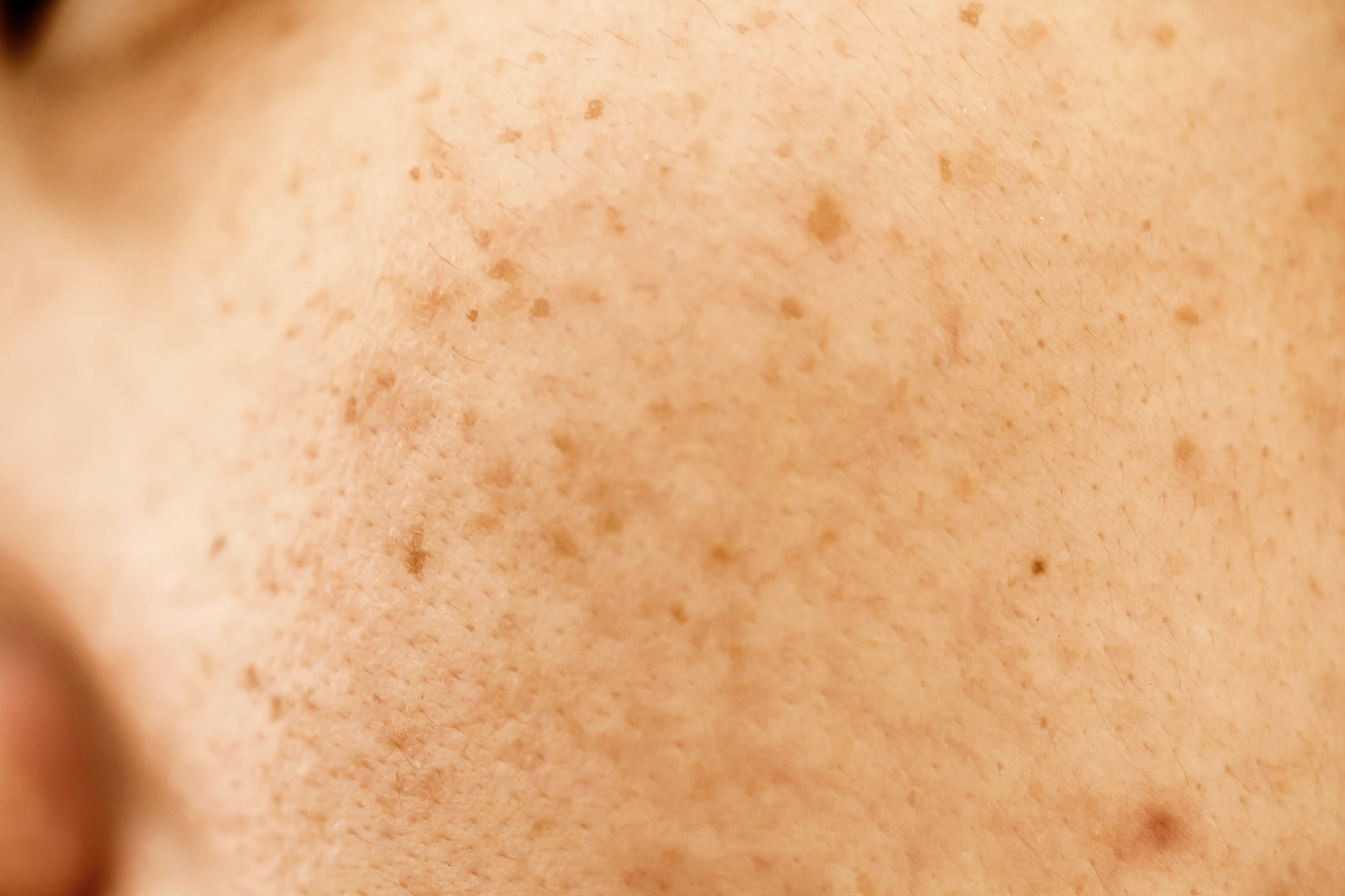 Facial blemishes: causes, types and how to treat pigmentation