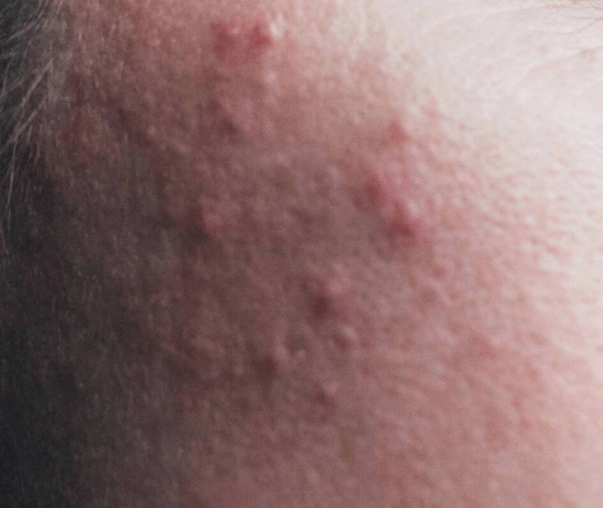 Close-up of skin with visible blemishes and texture