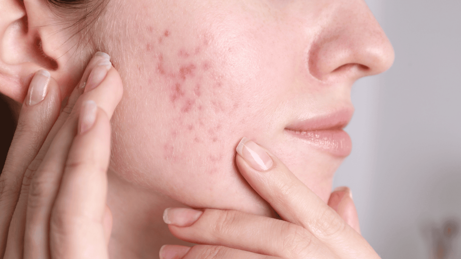 Summer acne: why breakouts happen in warmer weather