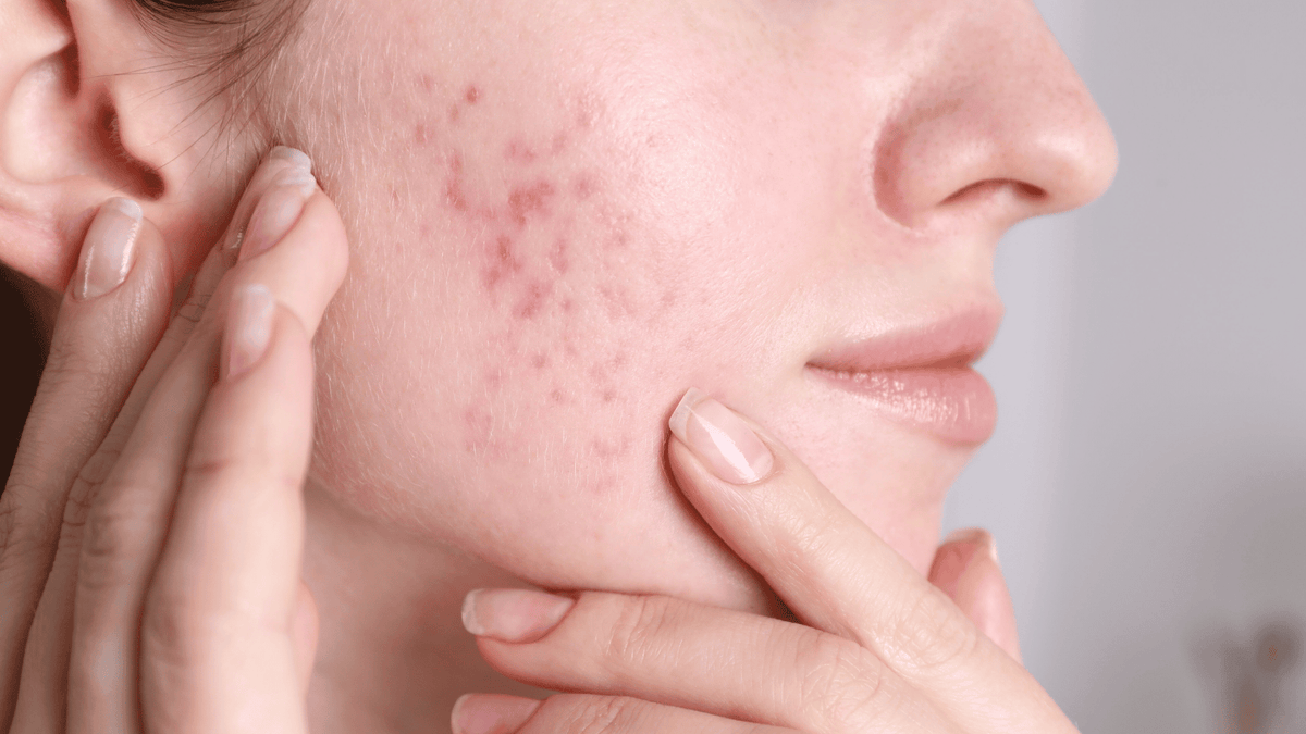 Summer acne: why breakouts happen in warmer weather