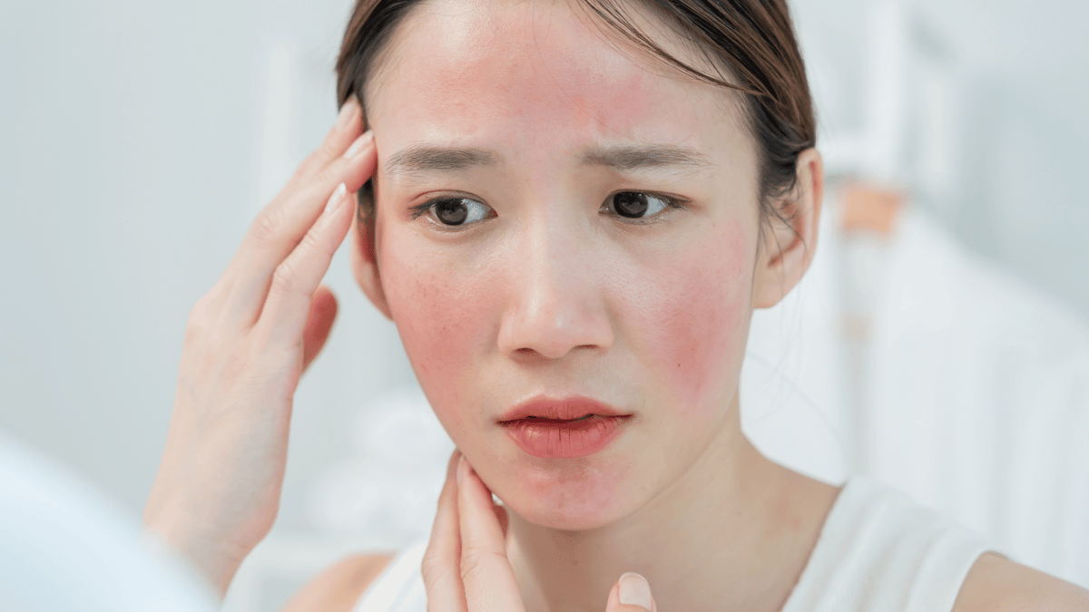 Redness in cold weather: how to care for sensitive and rosacea-prone skin
