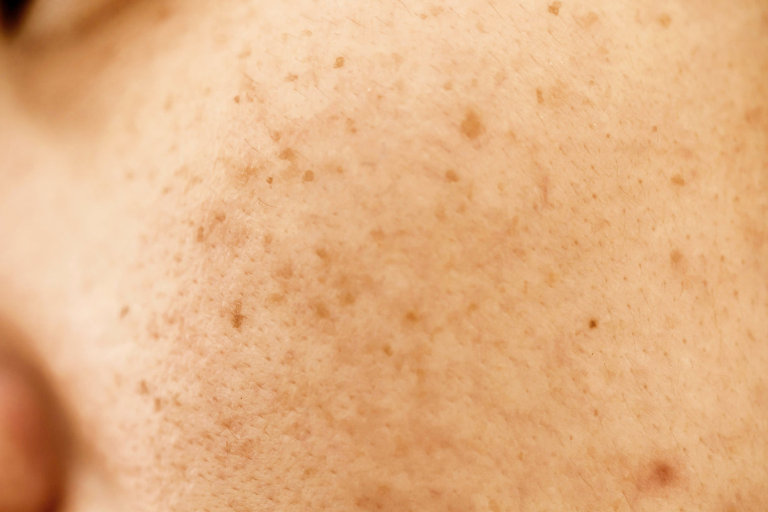 Facial Blemishes: Causes, Types and How to Treat Pigmentation