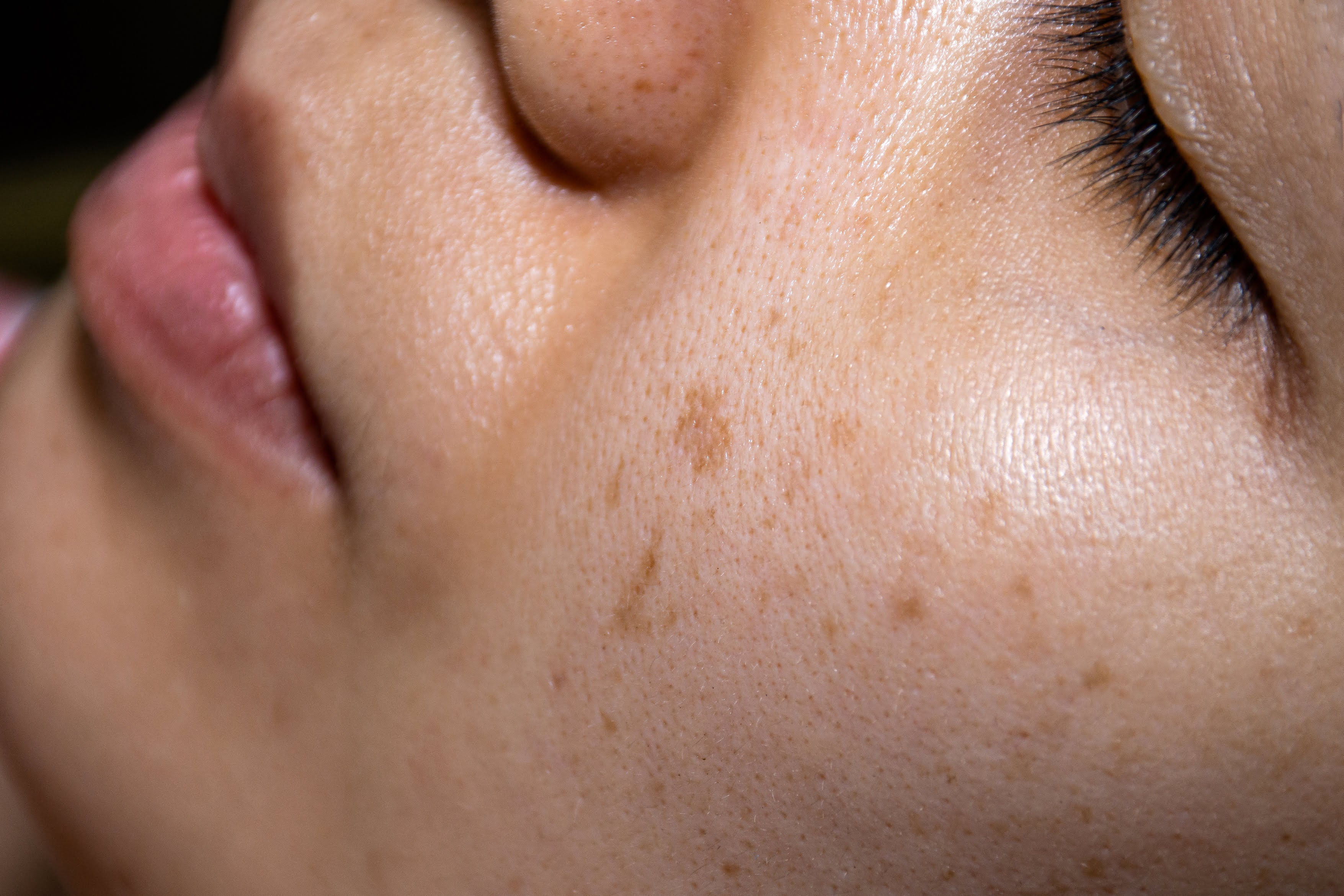Uneven Skin Tone