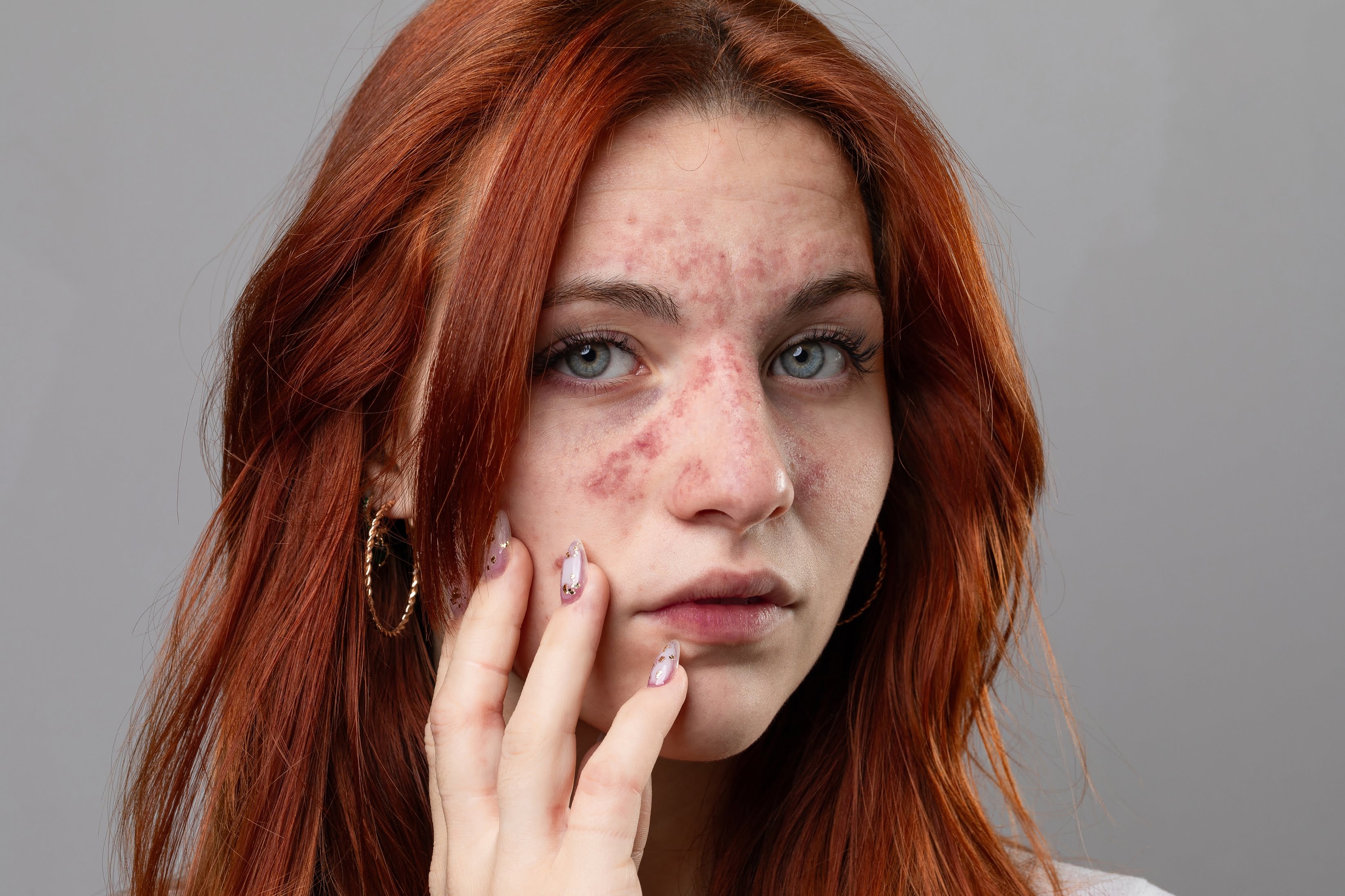 Redness & Rosacea