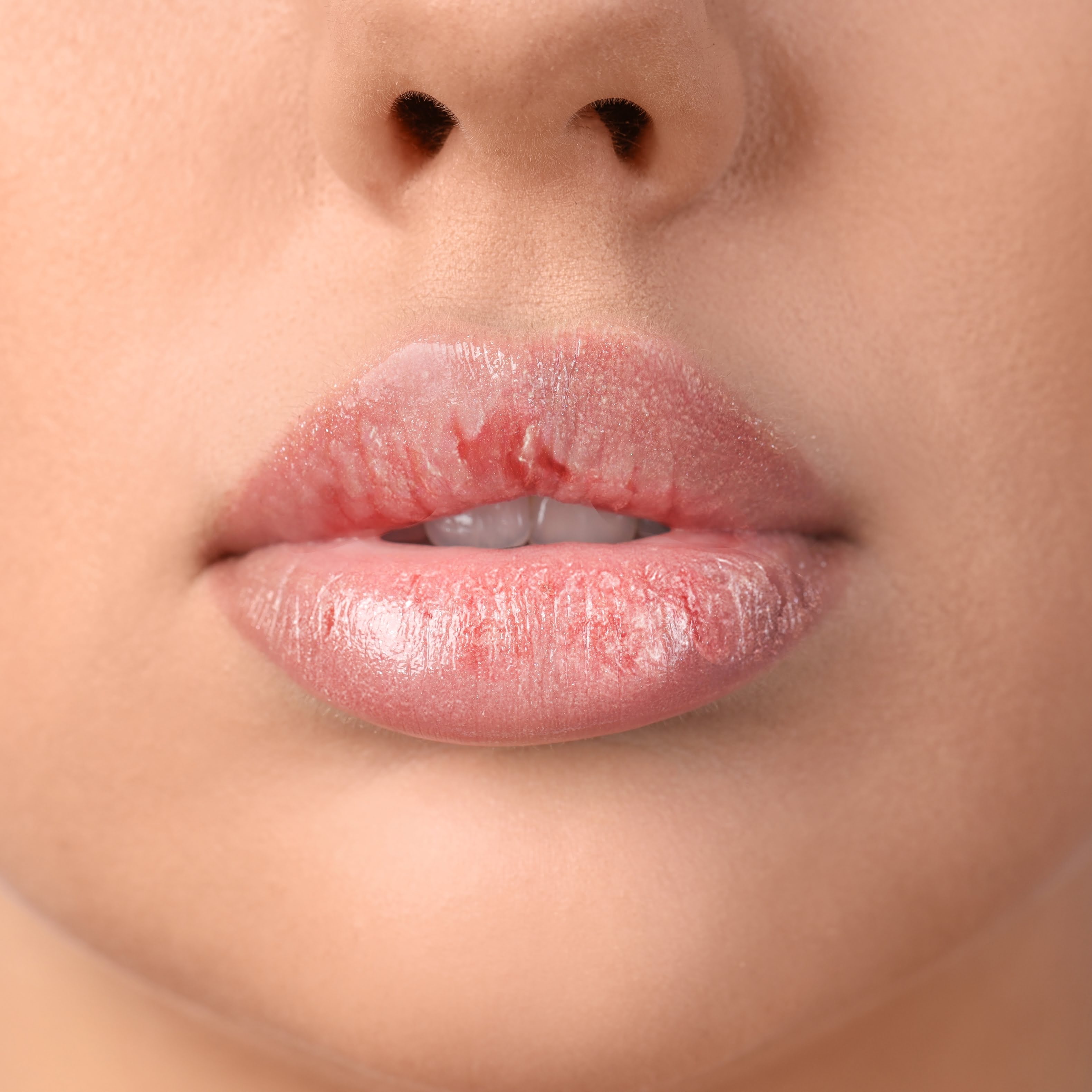 Dry Lips