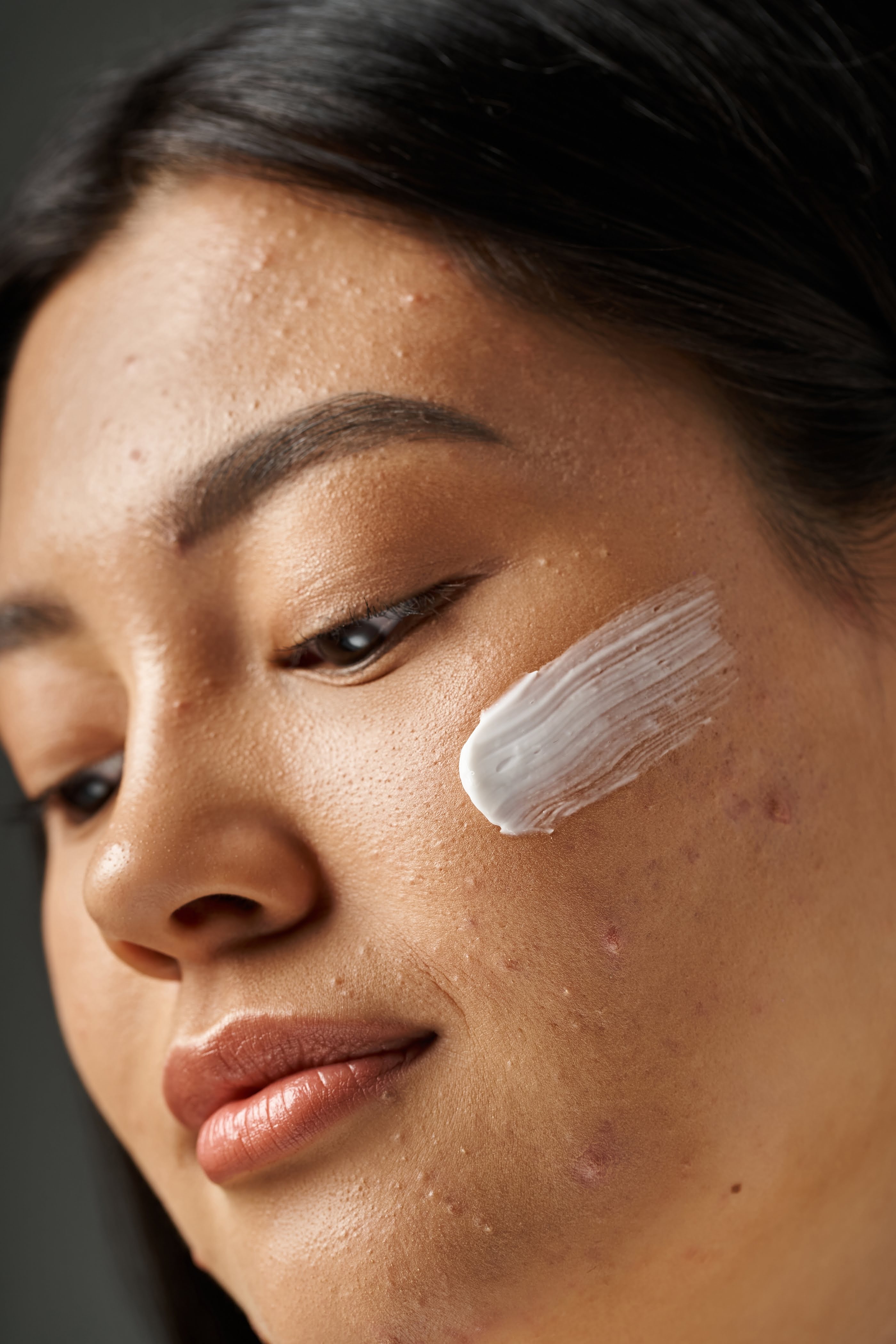 Acne Prone & Blemishes