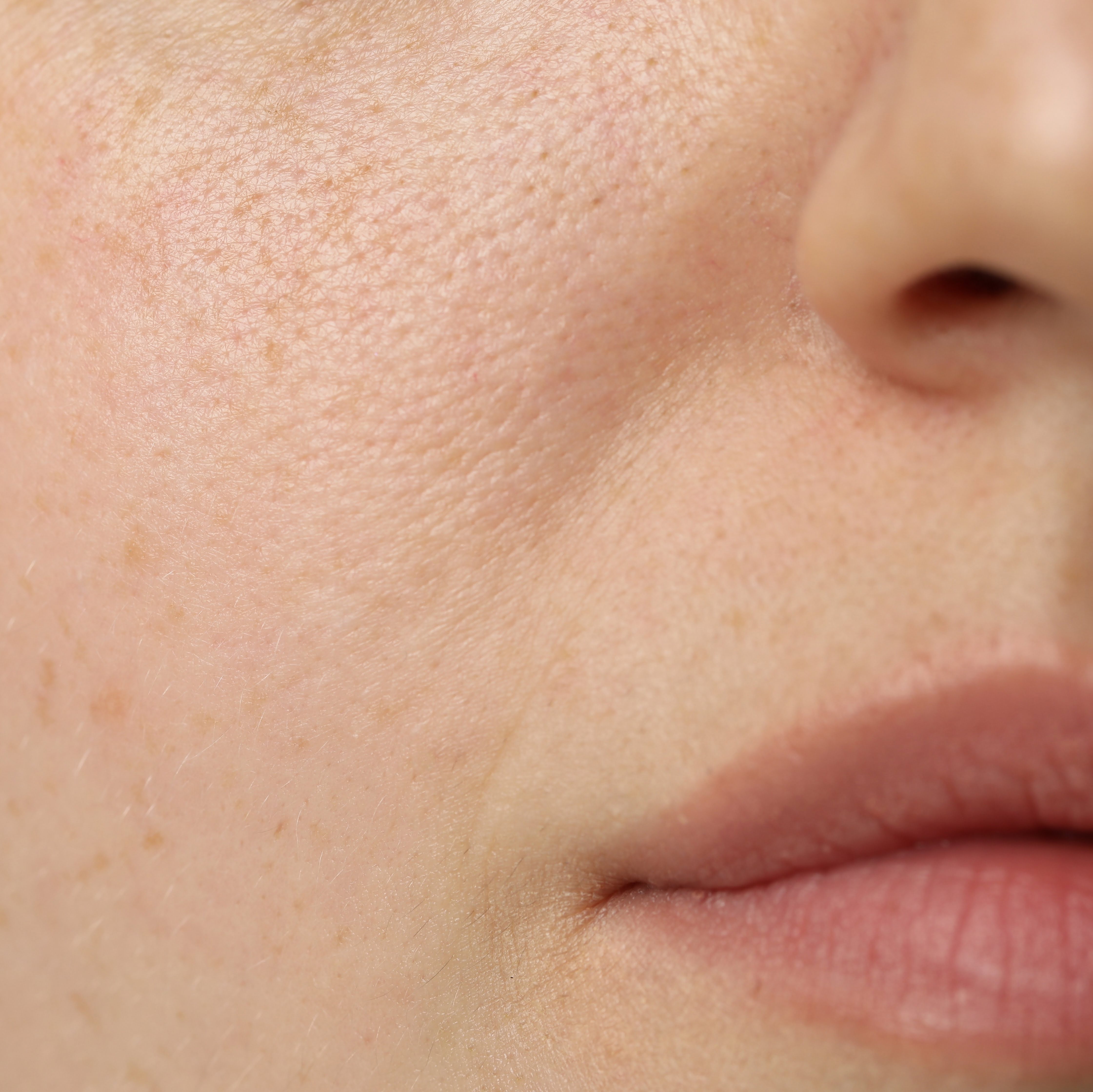 Dry Skin