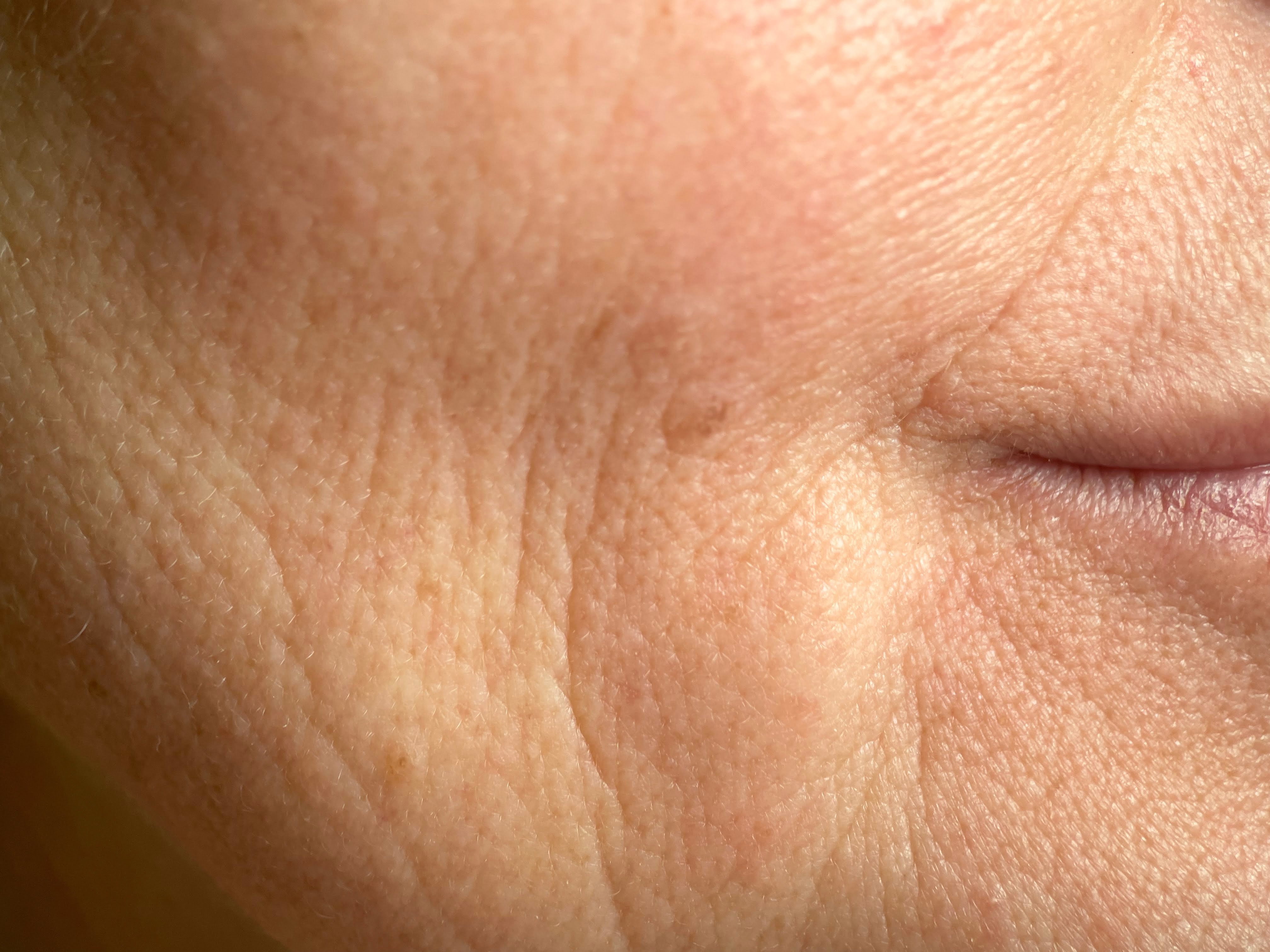 Fine Lines & Wrinkles