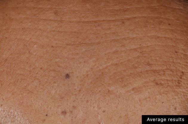 Close-up of skin texture with a small mole, labeled 'Average results'.