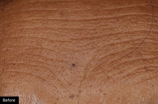 Close-up of skin texture with a blemish, labeled 'Before'.