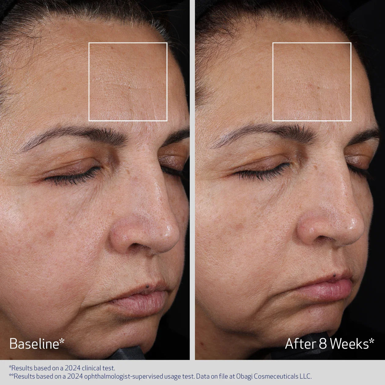 Before and after comparison of a woman's face with visible skin texture changes over 8 weeks