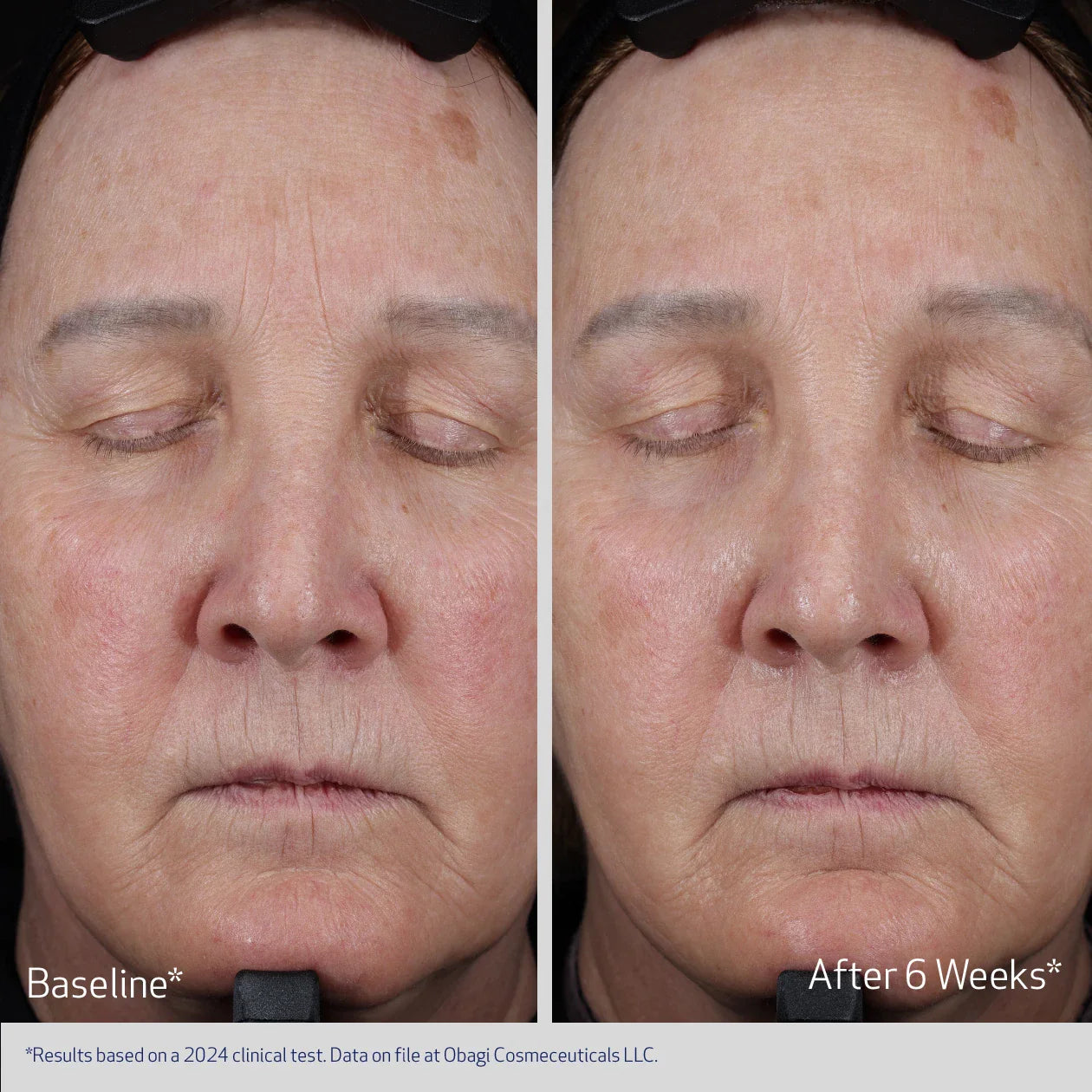 Before and after comparison of a person's face with visible skin texture changes
