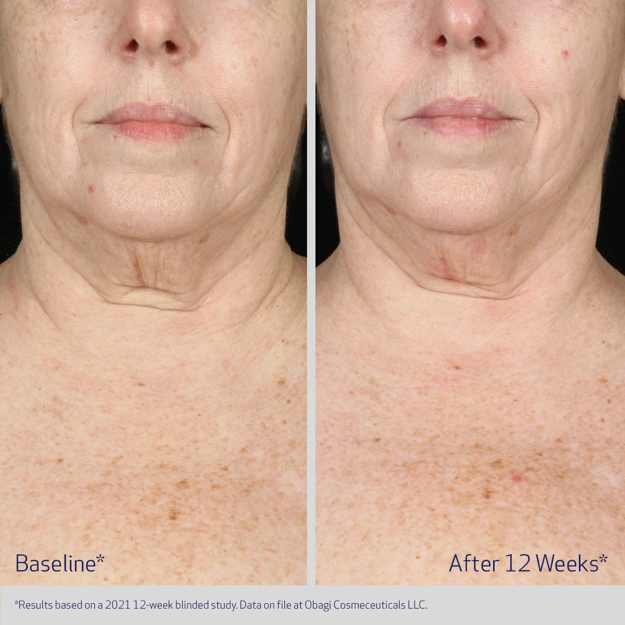Before and after comparison of a person's neck skin texture with text indicating results after 12 weeks.