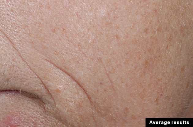 Close-up of skin with visible lines and texture, labeled 'Average results'.