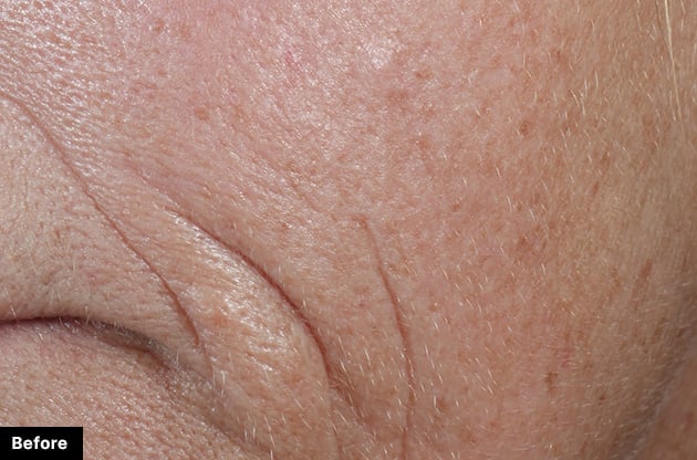 Close-up of skin with visible lines and texture, labeled 'Before'.