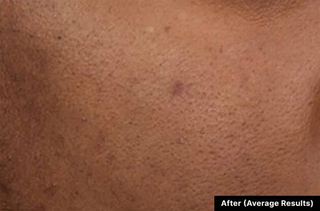 Close-up of skin texture labeled 'After (Average Results)'