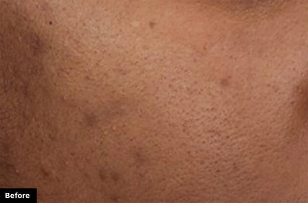 Close-up of skin texture labeled 'Before' on a brown background
