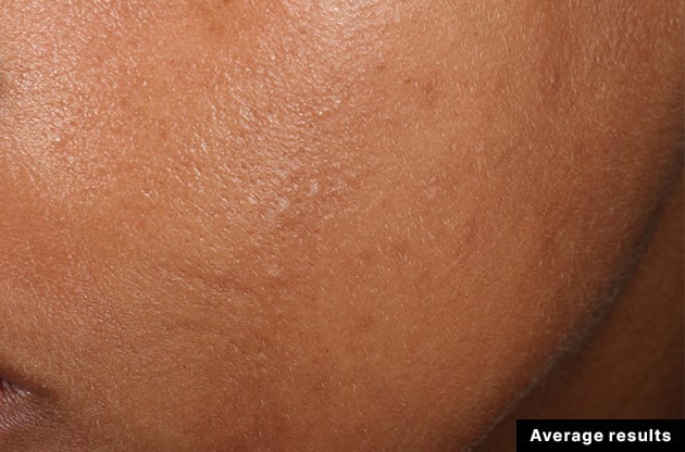 Close-up of skin with visible pores and texture, labeled 'Average results'.