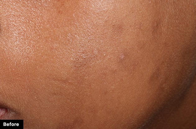 Close-up of skin with visible blemishes labeled 'Before'.