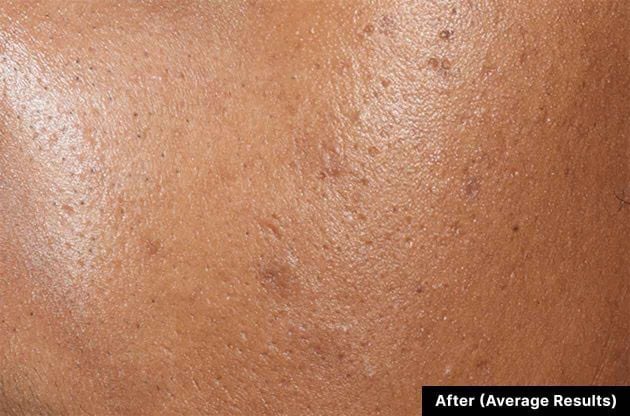 Close-up of skin texture labeled 'After (Average Results)'