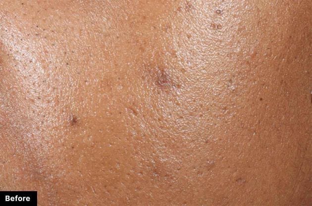 Close-up of skin texture with pores and blemishes, labeled 'Before'.