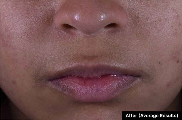 Close-up of a person's lips with 'After (Average Results)' text