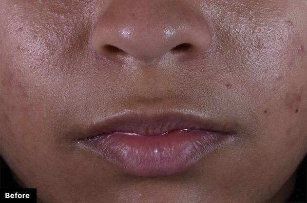 Close-up of a person's lips with visible skin texture and pores.