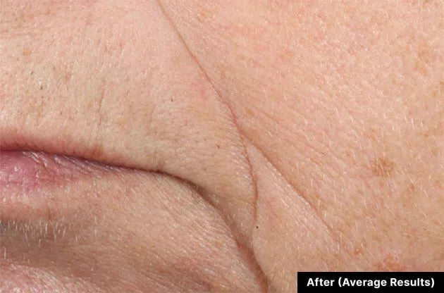 Close-up of skin with visible lines and texture after treatment.