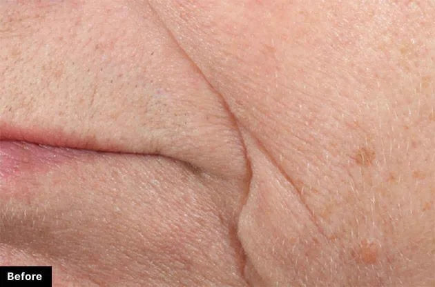 Close-up of skin texture with 'Before' label