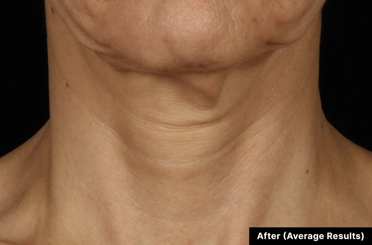 Close-up of a neck with visible skin texture and lines, labeled 'After (Average Results)'.