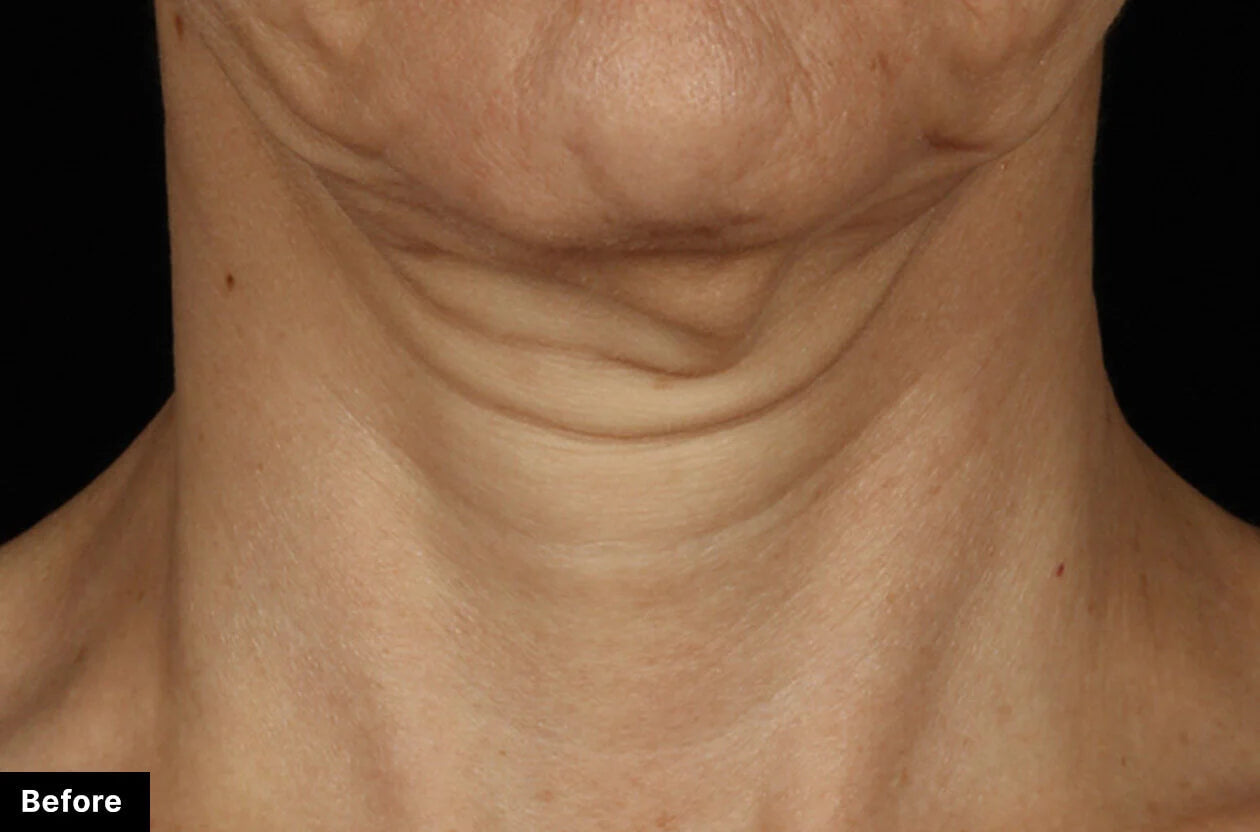 Close-up of neck skin with visible wrinkles and texture, labeled 'Before'.
