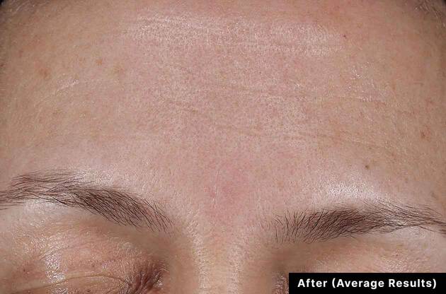Close-up of a person's eye area with 'After (Average Results)' text