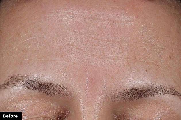 Close-up of a person's forehead with visible wrinkles, labeled 'Before'.