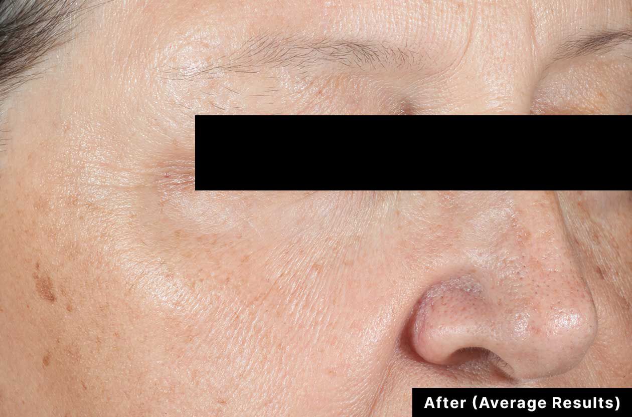 Close-up of a person's face with skin texture and blemishes, labeled 'After (Average Results)'.