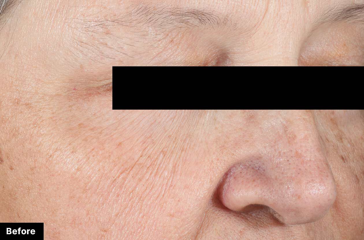 Close-up of a person's face with visible skin texture and lines, labeled 'Before'.