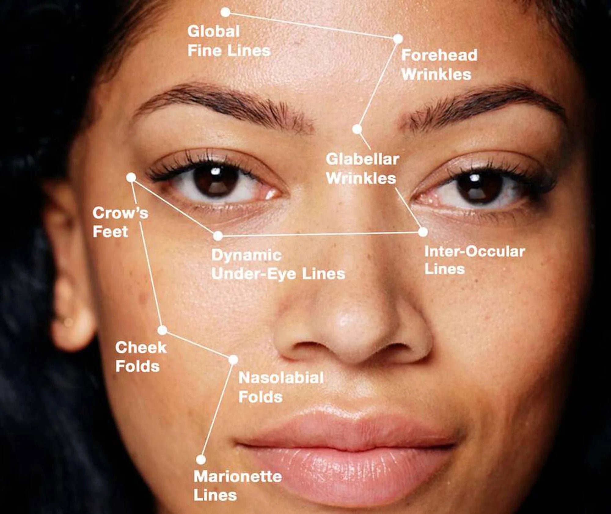Facial wrinkles labeled on a woman's face with a dark background