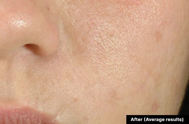 Close-up of skin texture labeled 'After (Average results)'