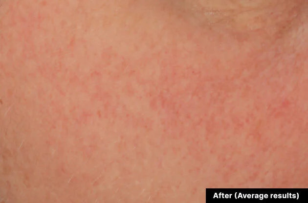 Close-up of skin with redness labeled 'After (Average results)'