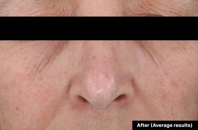 Close-up of a person's nose with a black bar across it, labeled 'After (Average results)'.