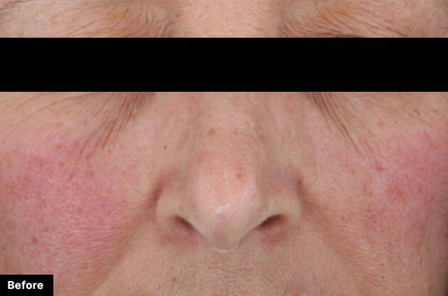 Close-up of a person's face with visible skin texture and redness, labeled 'Before'.