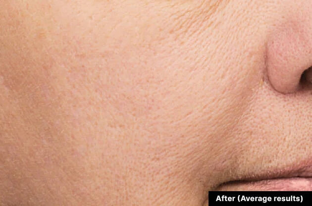 Close-up of a person's skin with 'After (Average results)' text