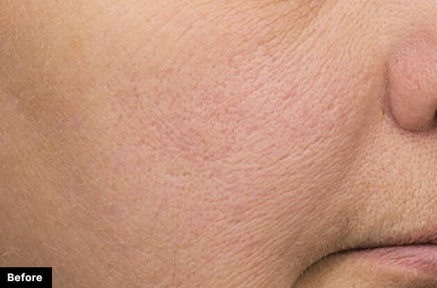 Close-up of skin texture with 'Before' label