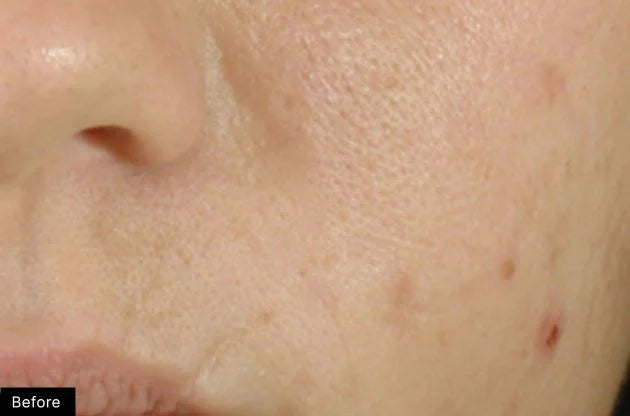 Close-up of skin with blemishes labeled 'Before'.