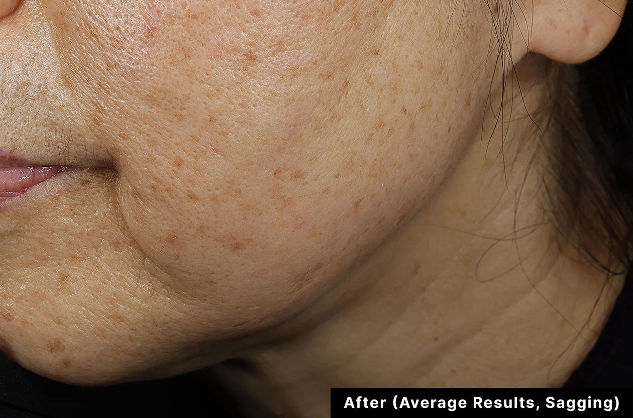 Close-up of a person's neck and jawline with visible skin texture and sagging, labeled 'After (Average Results, Sagging)'.