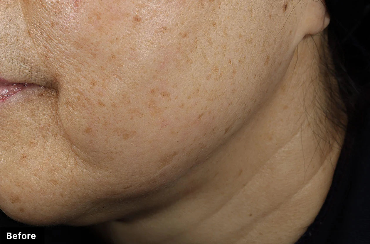 Close-up of a person's neck with visible skin texture and slight swelling.
