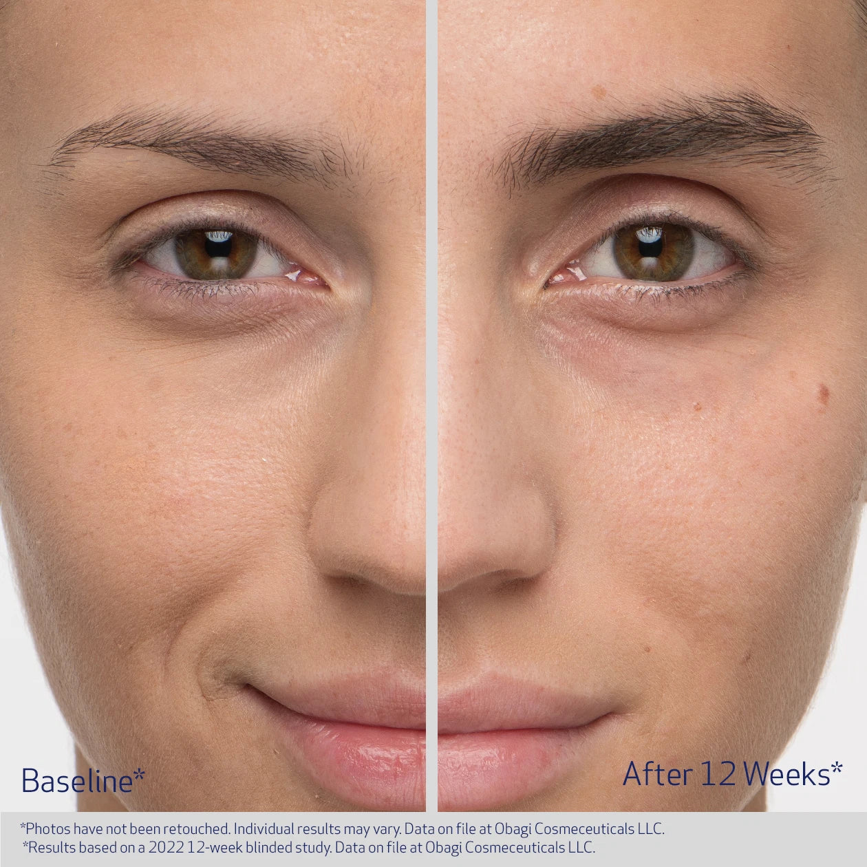 Before and after comparison of a person's eye area with text indicating results after 12 weeks.