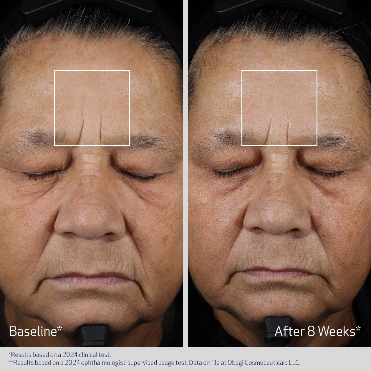 Before and after comparison of a person's face with visible wrinkles, showing results after 8 weeks