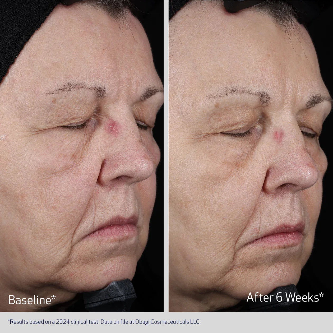 Before and after comparison of a person's face with visible skin texture changes over 6 weeks