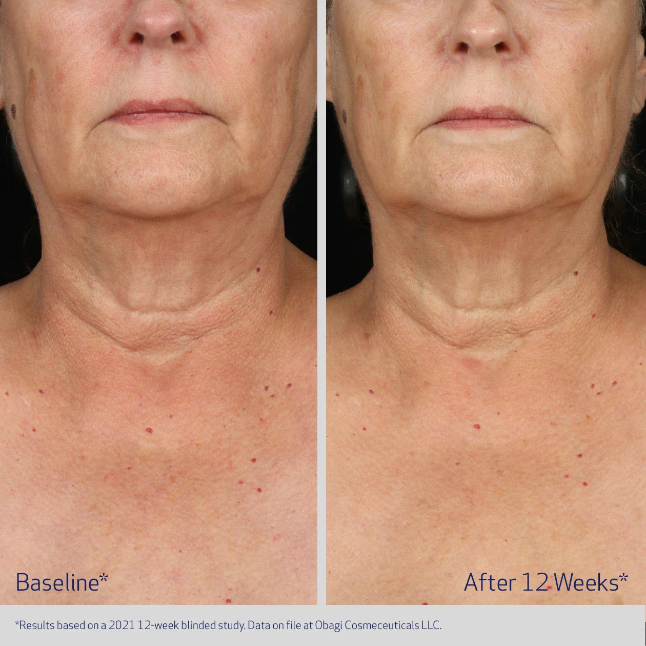 Before and after comparison of a woman's neck skin texture with visible results after 12 weeks.